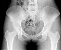 DePuy Hip Replacements Recalled